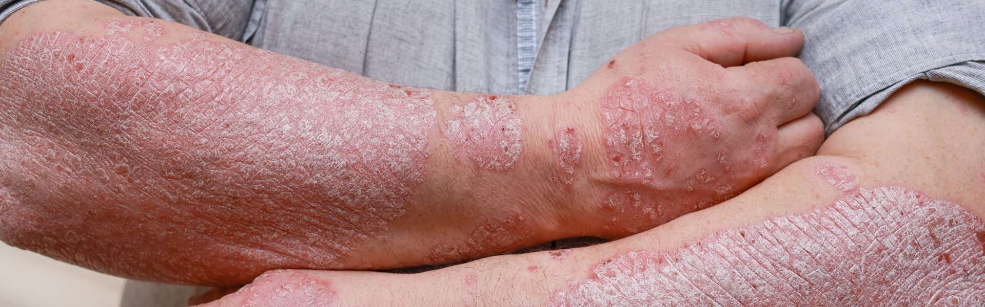 Arms Showing Skin Condition Psoriasis